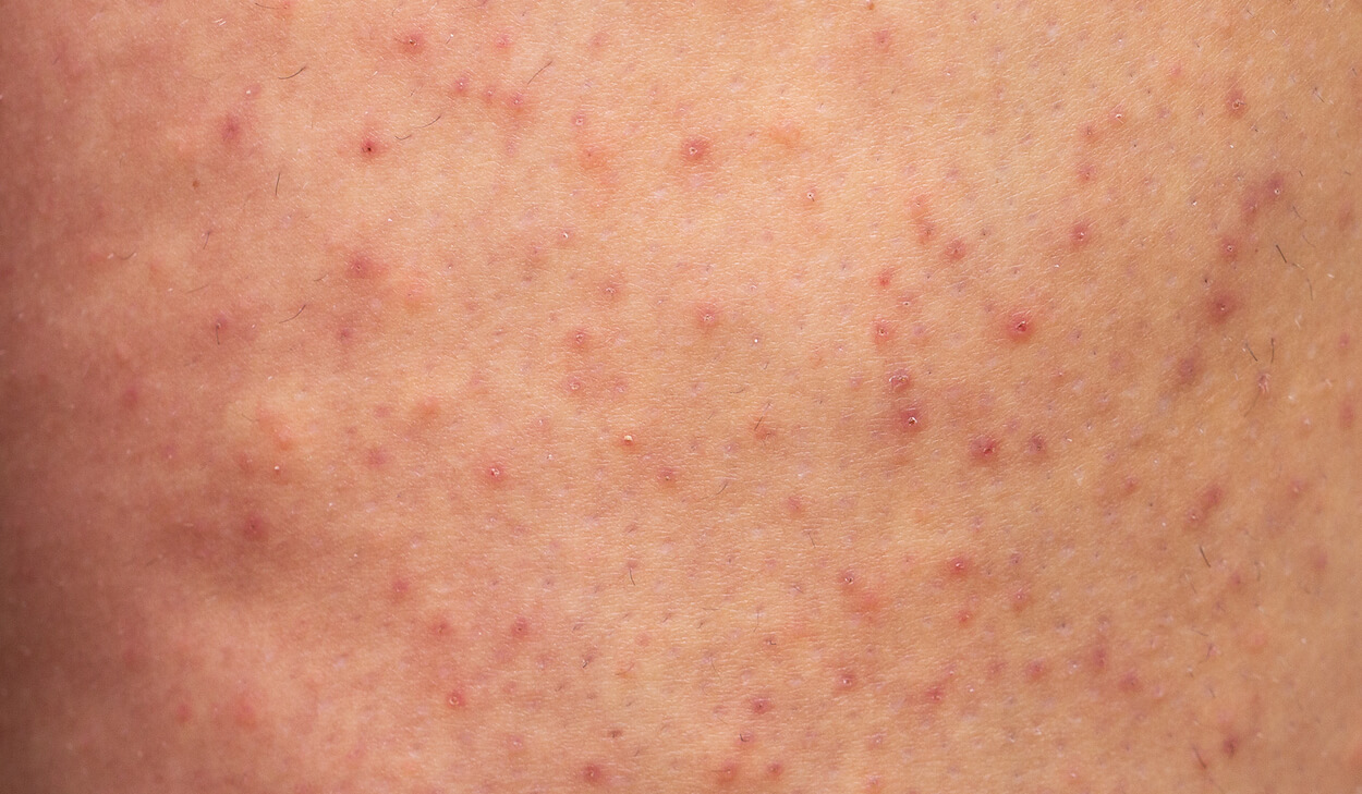Ansigtshud med keratosis pilaris