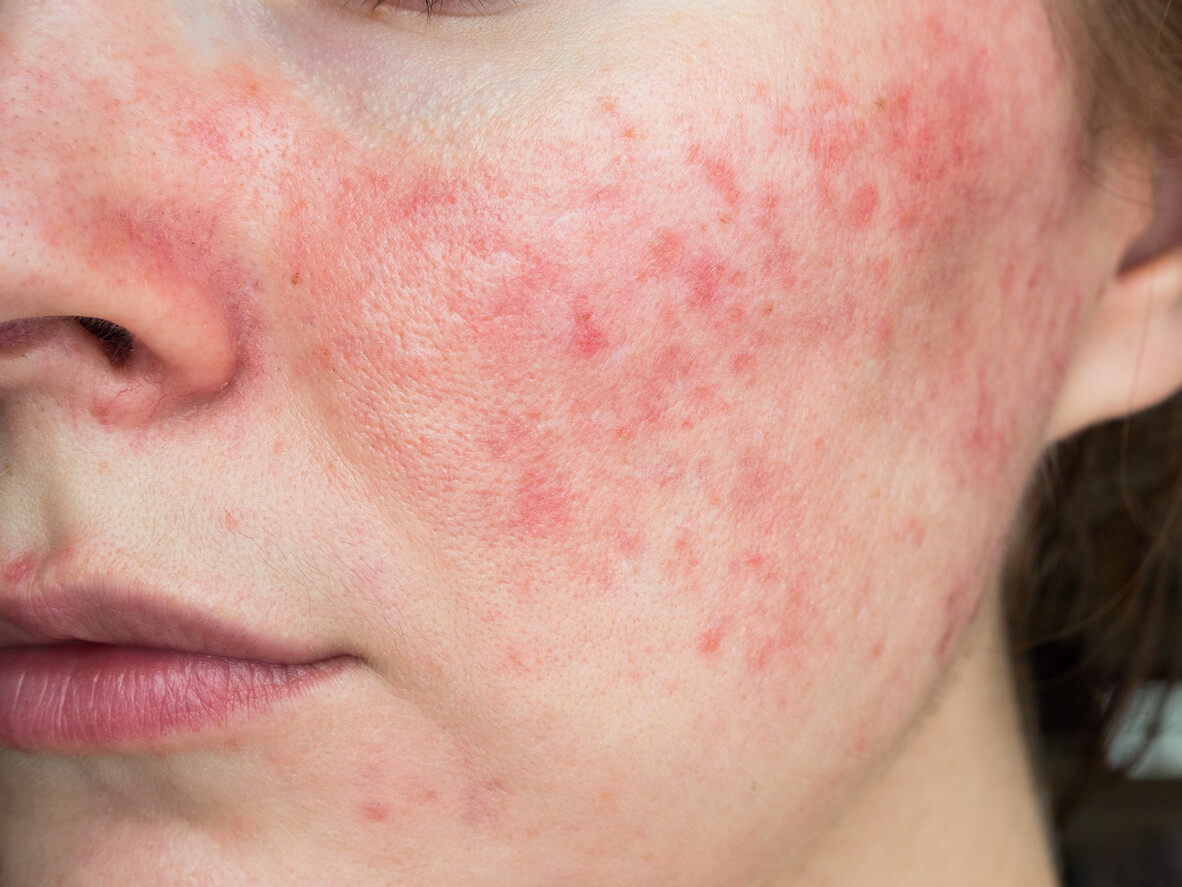 Ansigtshud med Rosacea