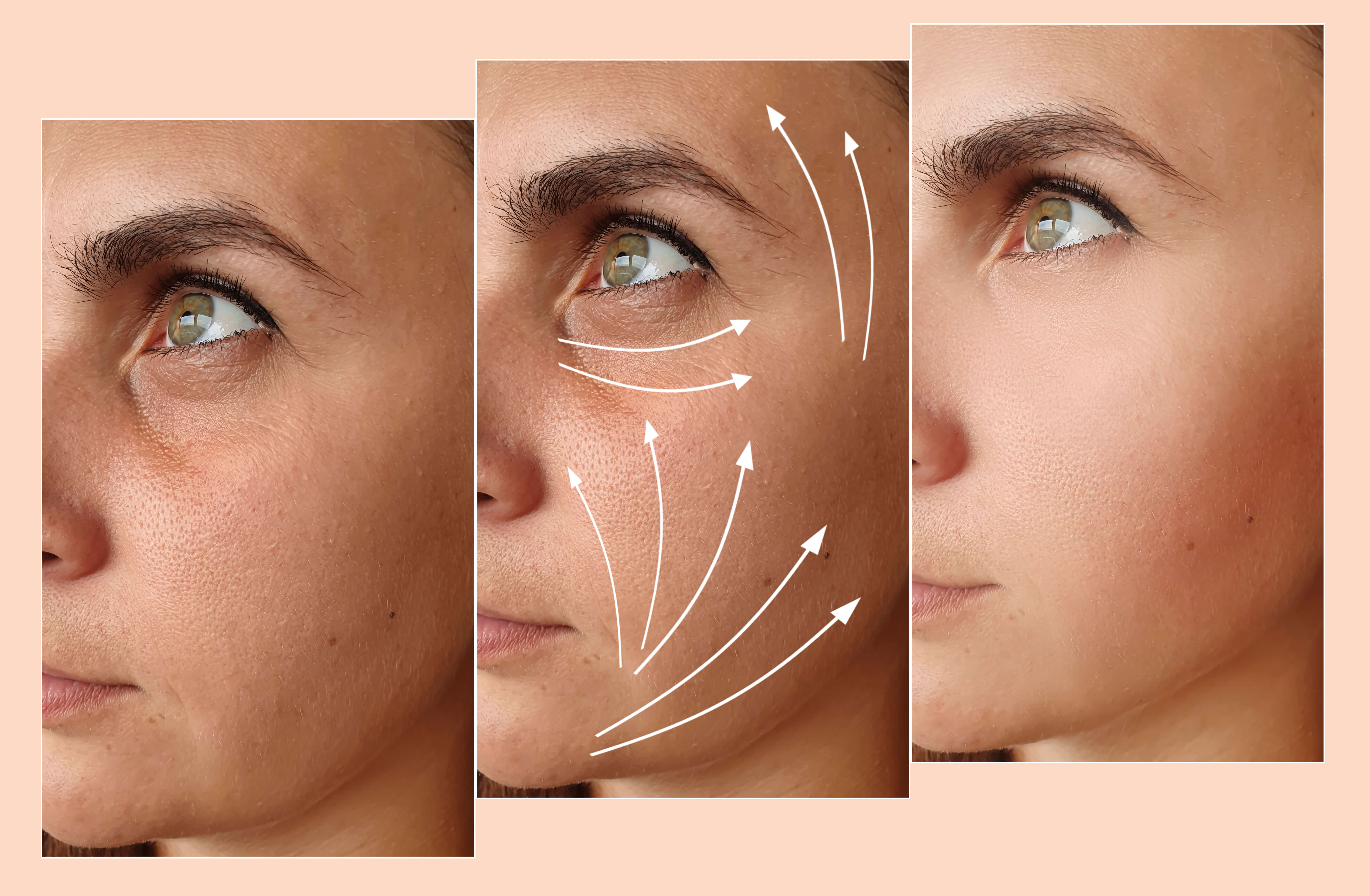 Før og efter billede af kvinde der bruger retinol serum