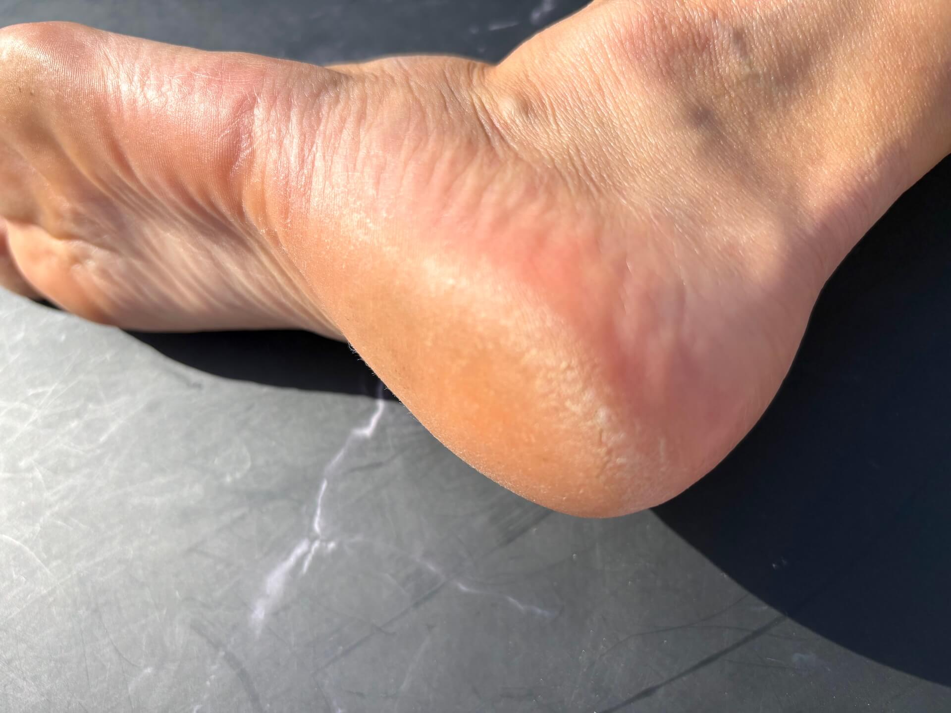 Underside af fod før brug af Cana Care RELIEF Bath Salt